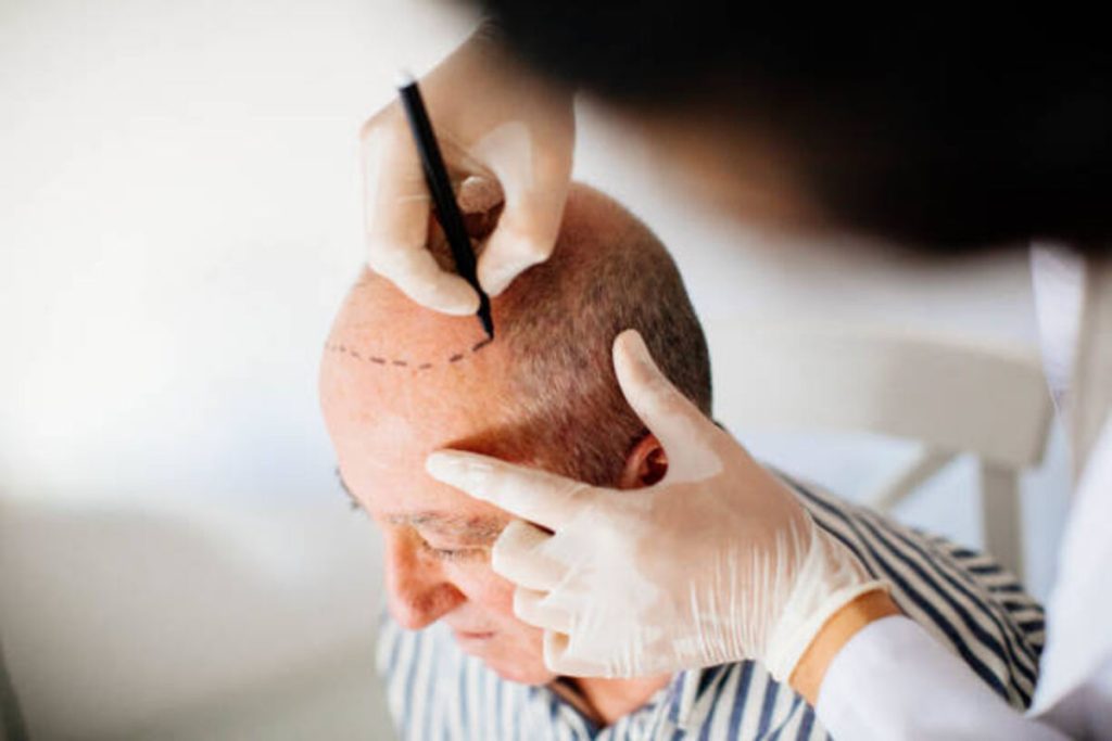 best hair restoration doctor in Arizona