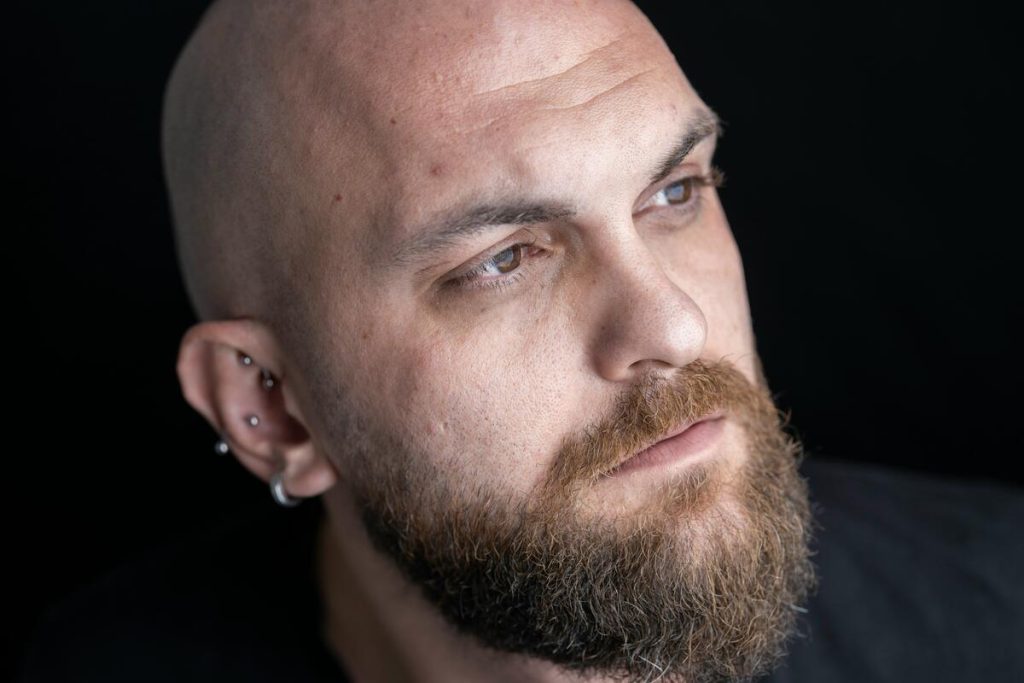 Hair transplant in Turkey
