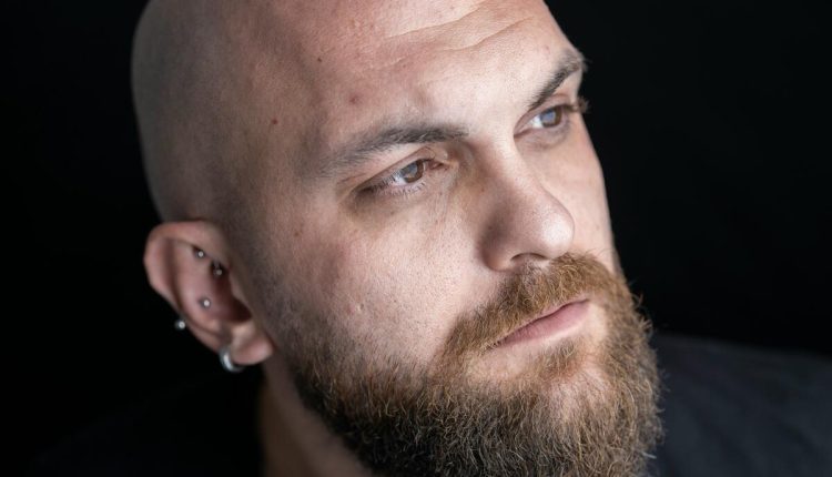 Hair transplant in Turkey